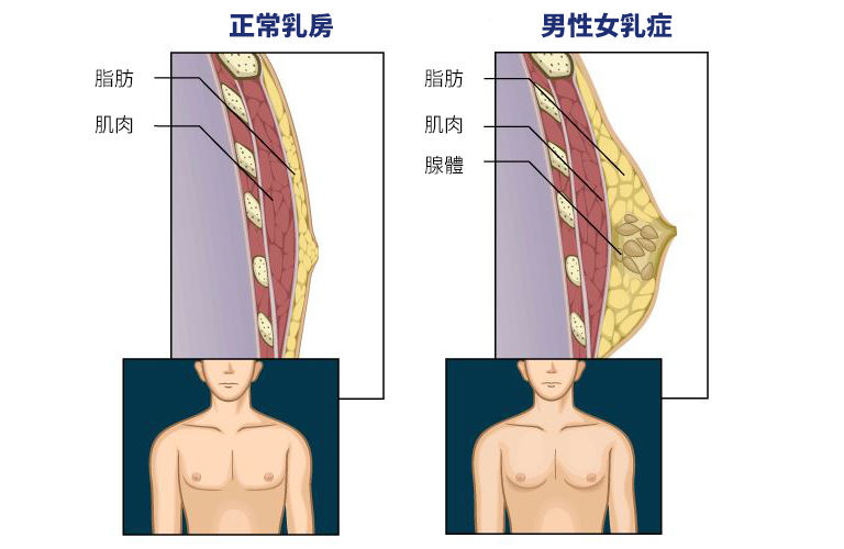 男性女乳症成因示意圖