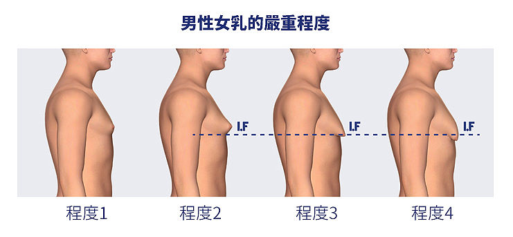 男性女乳症嚴重程度示意圖