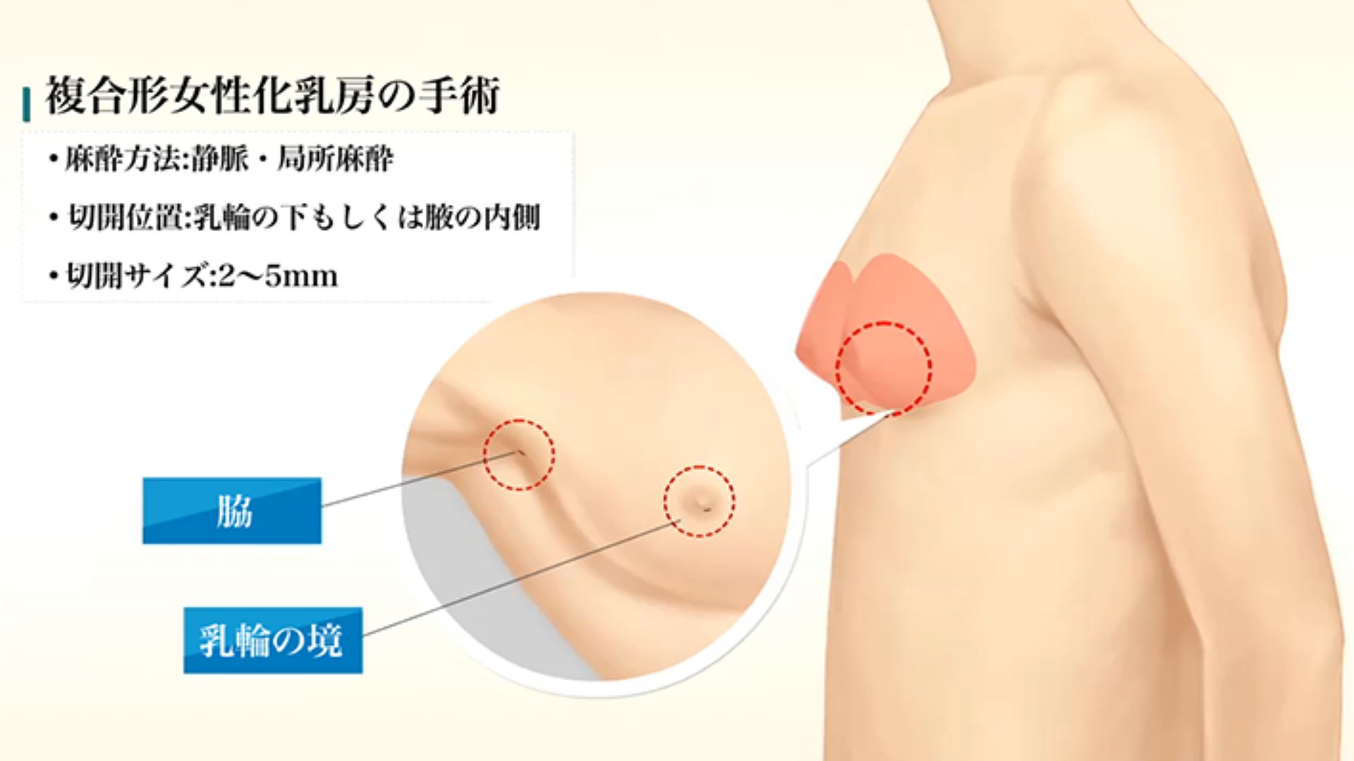 複合型男性女乳症手術示意圖3