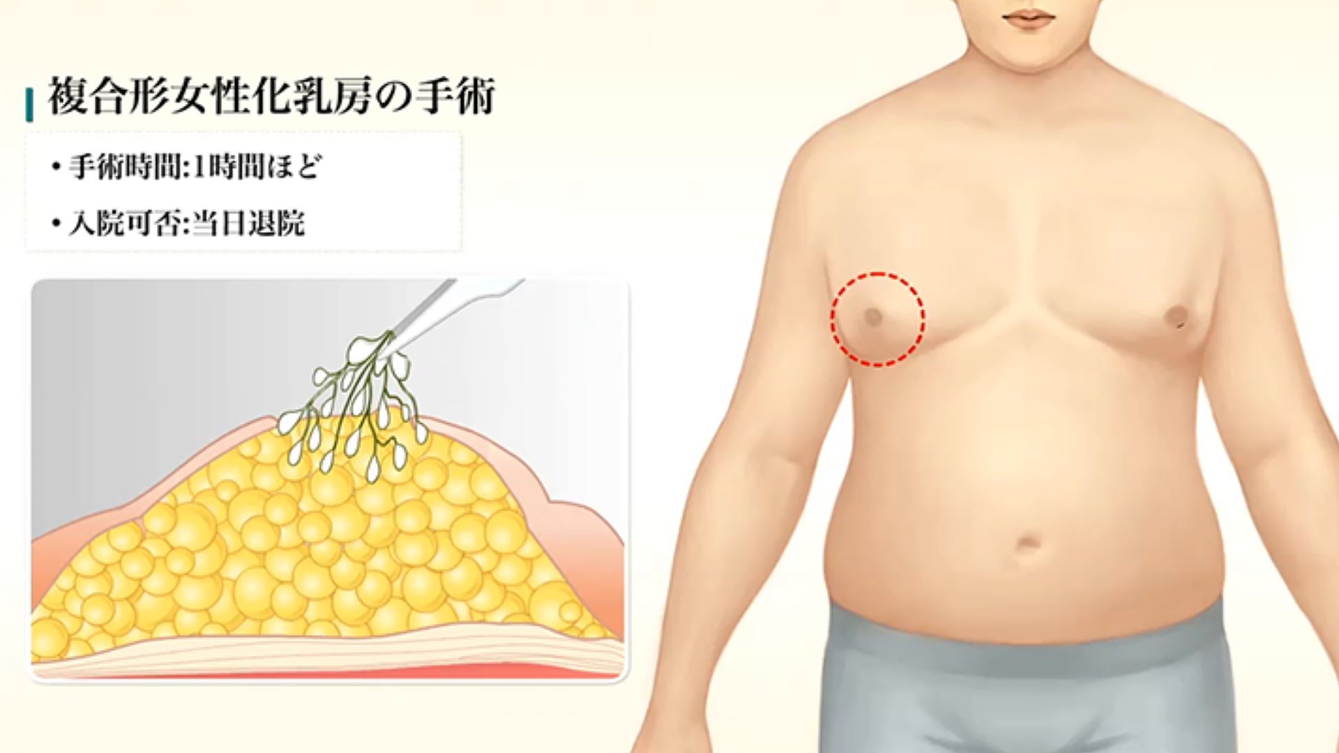 複合型男性女乳症手術示意圖1
