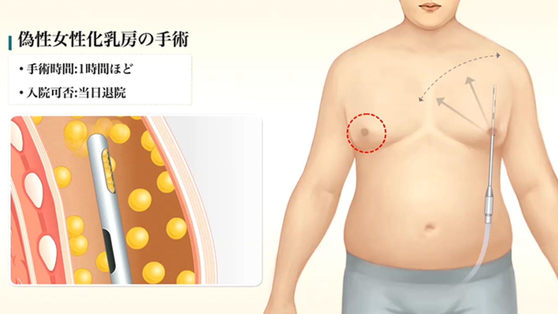脂肪型男性女乳手術示意圖