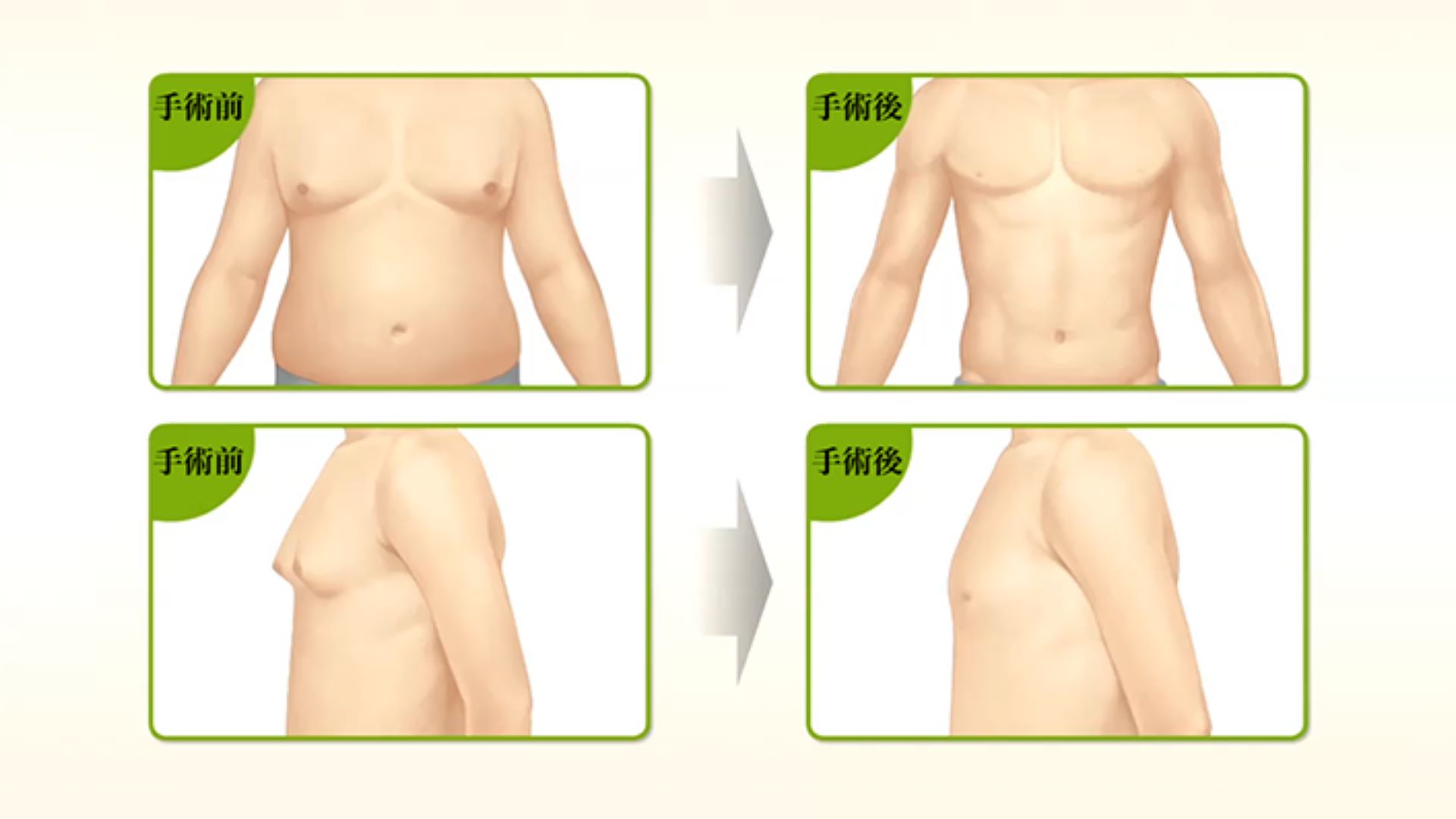 台中男性女乳症手術權威醫師推薦價格費用012