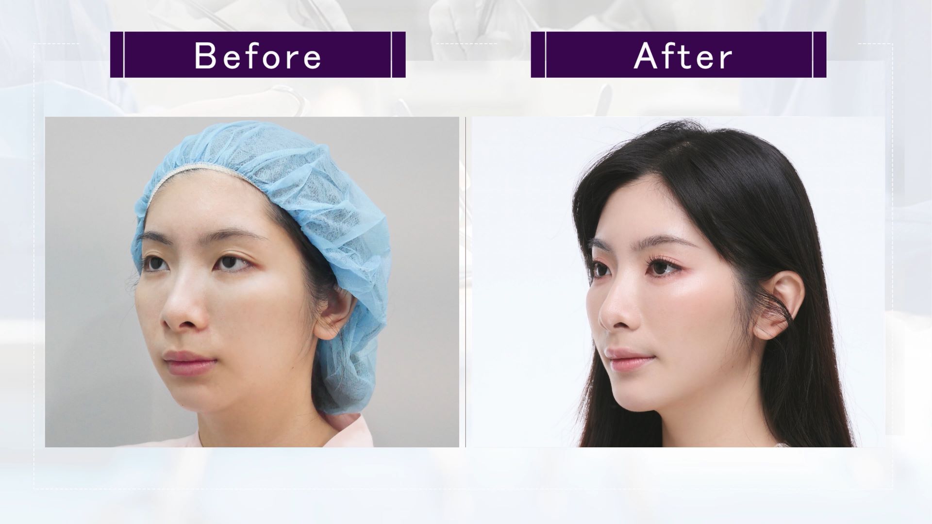 台中墊下巴整形手術權威醫師推薦價格費用004