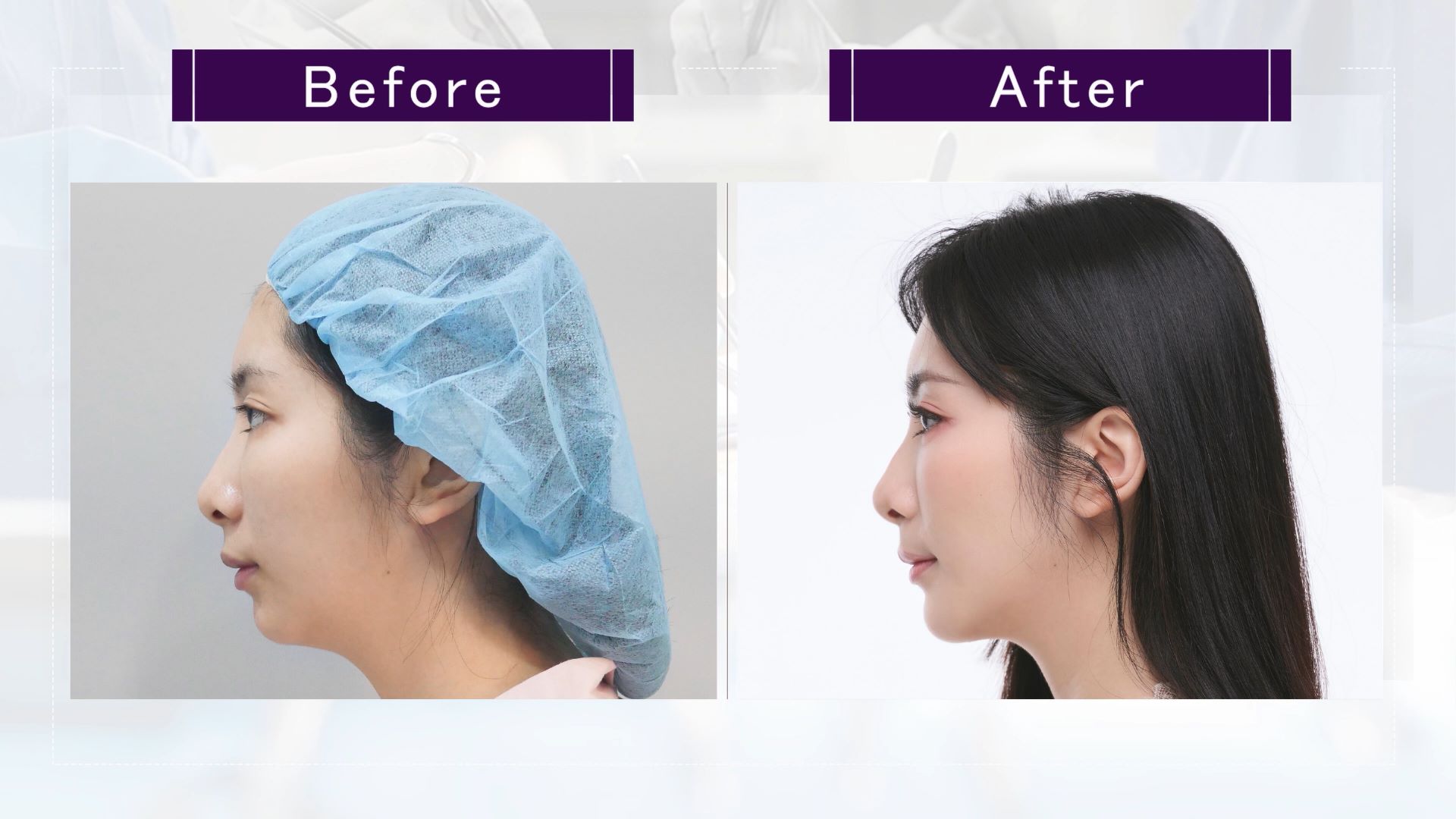 台中墊下巴整形手術權威醫師推薦價格費用005