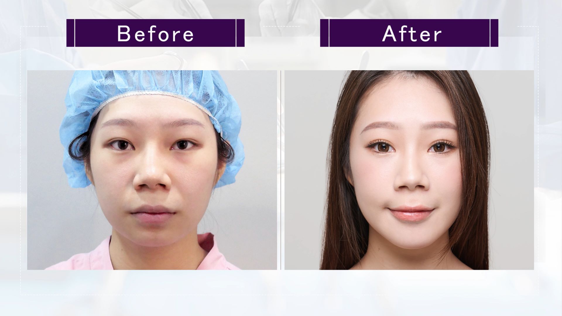 台中墊下巴整形手術權威醫師推薦價格費用001