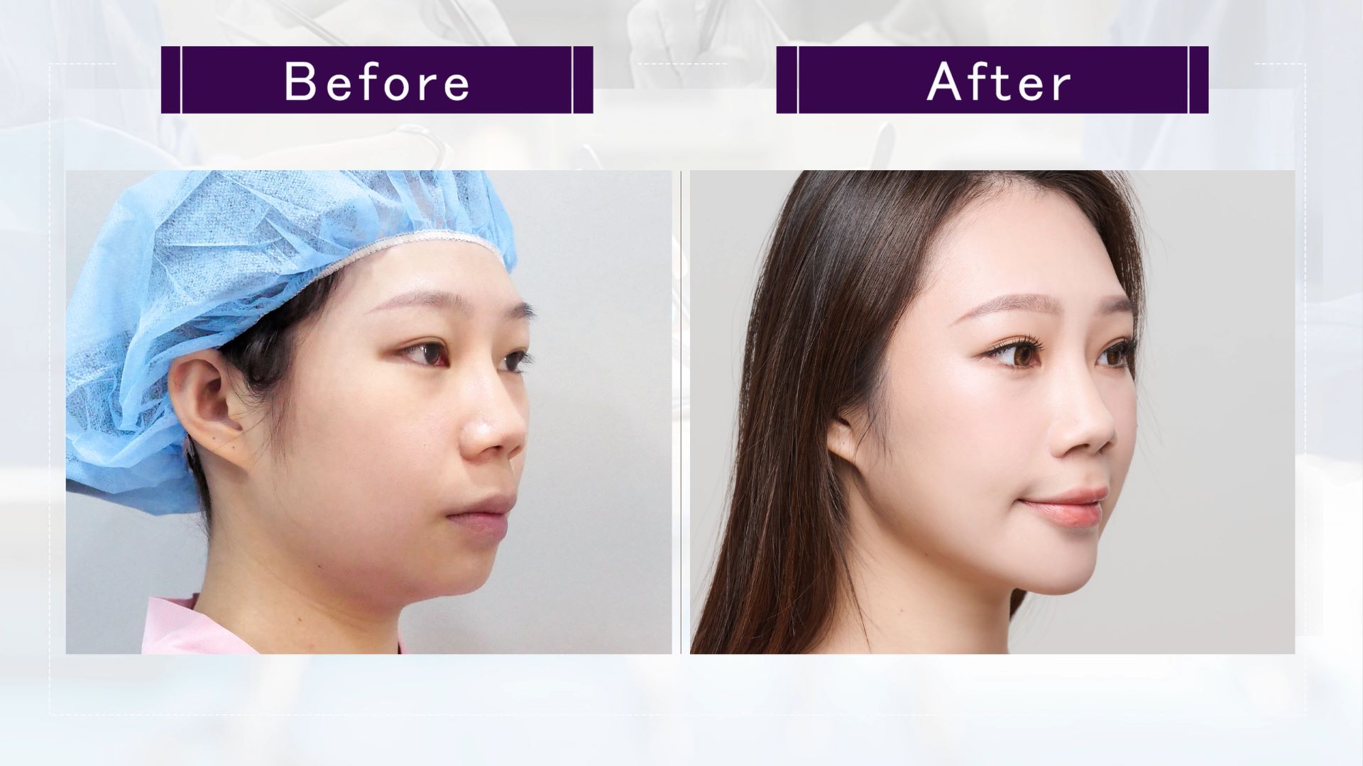 台中墊下巴整形手術權威醫師推薦價格費用002