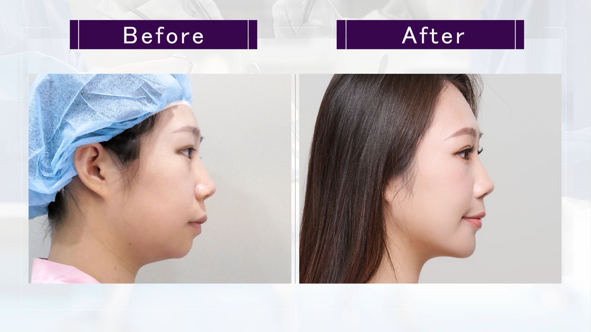 台中墊下巴整形手術權威醫師推薦價格費用003