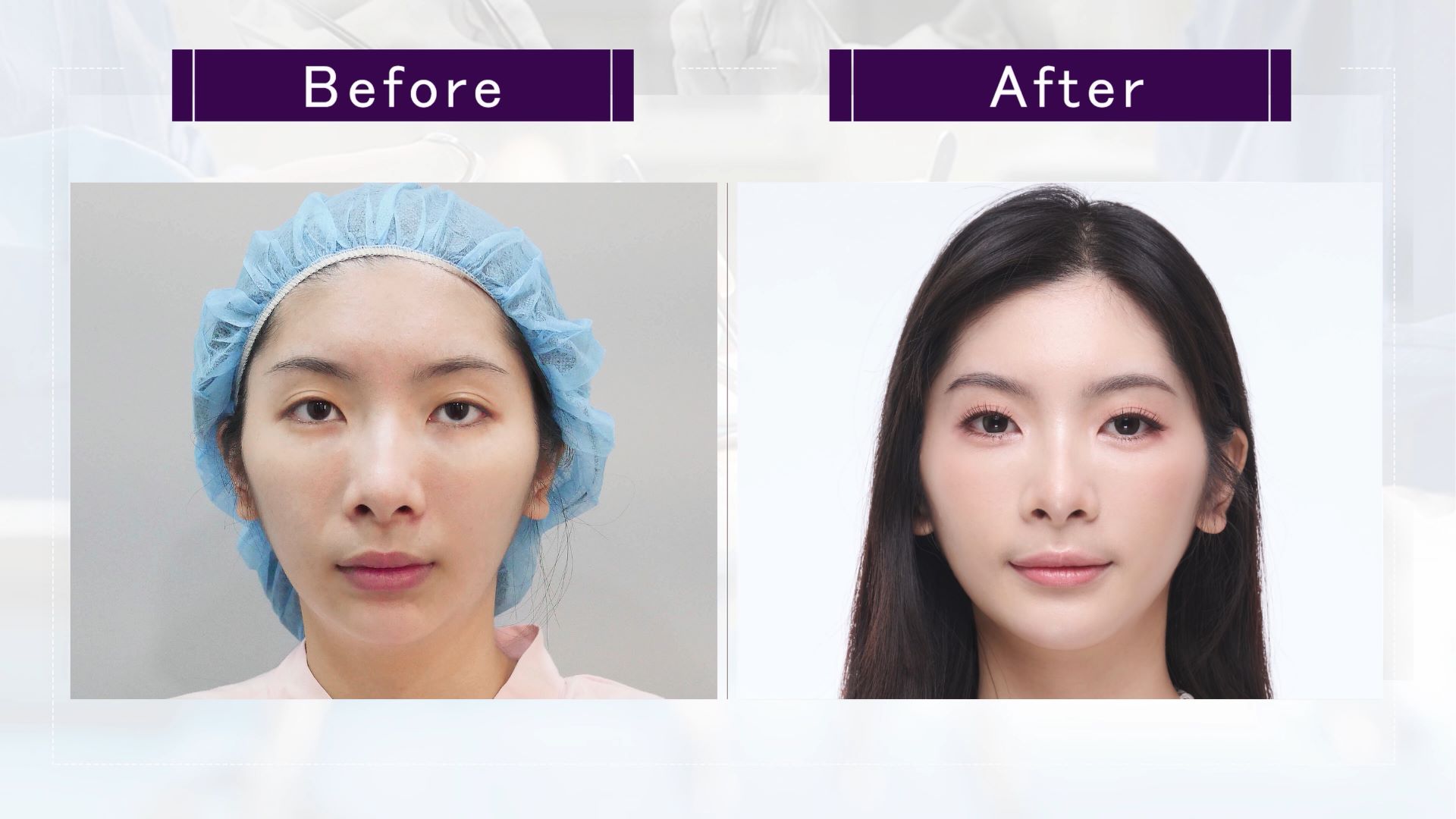 台中墊下巴整形手術權威醫師推薦價格費用006