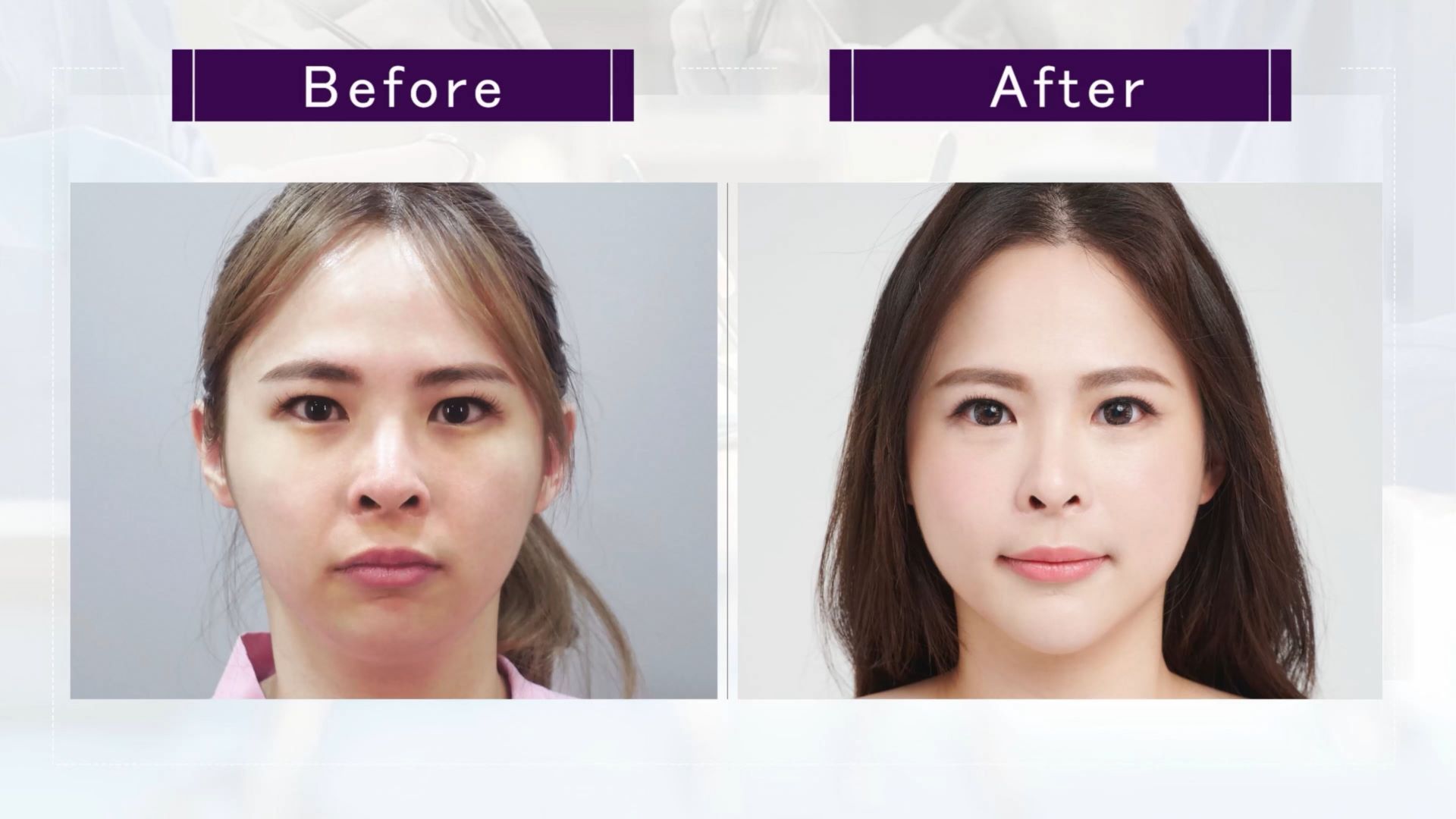 台中墊下巴整形手術權威醫師推薦價格費用007