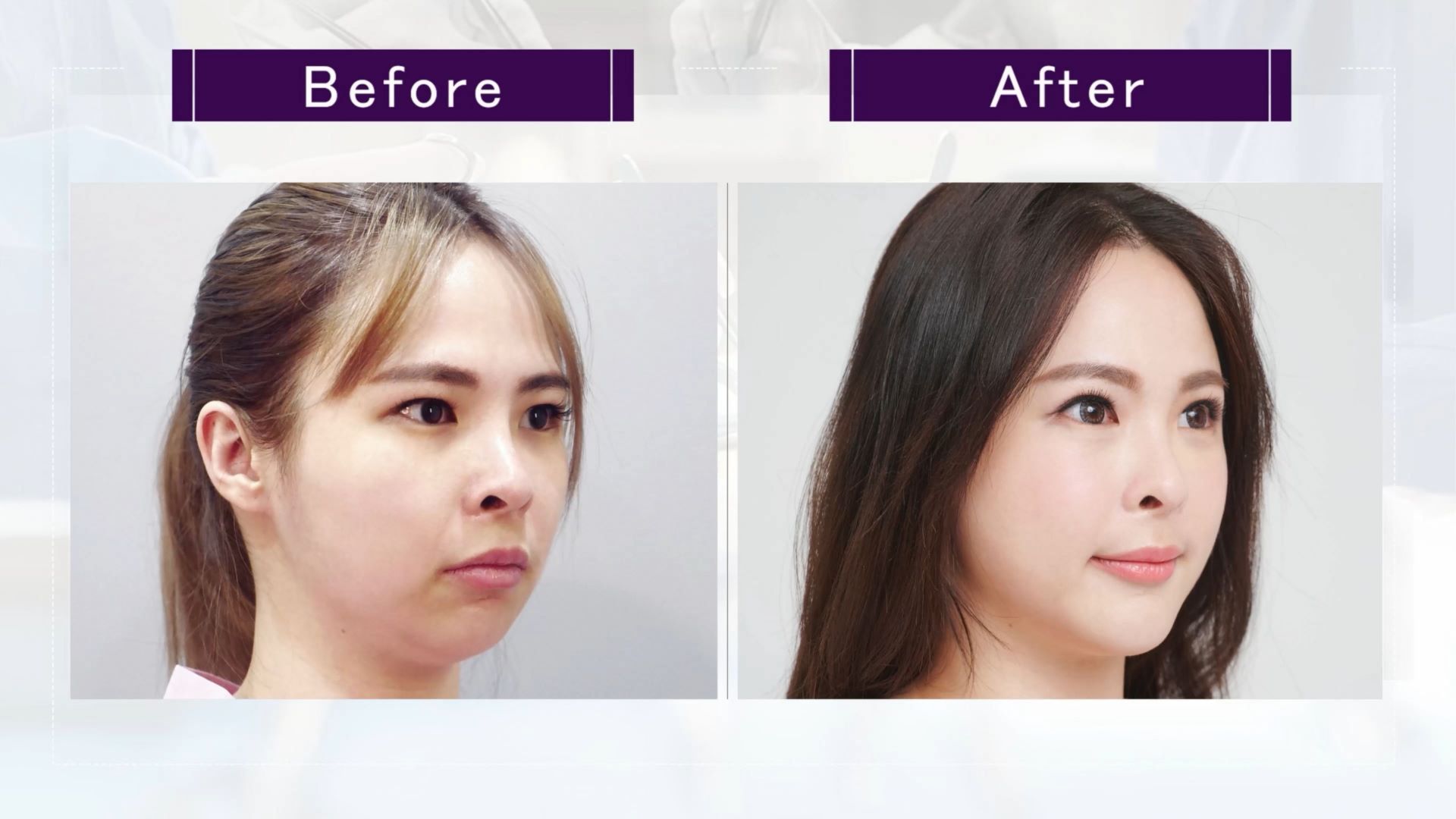 台中墊下巴整形手術權威醫師推薦價格費用008