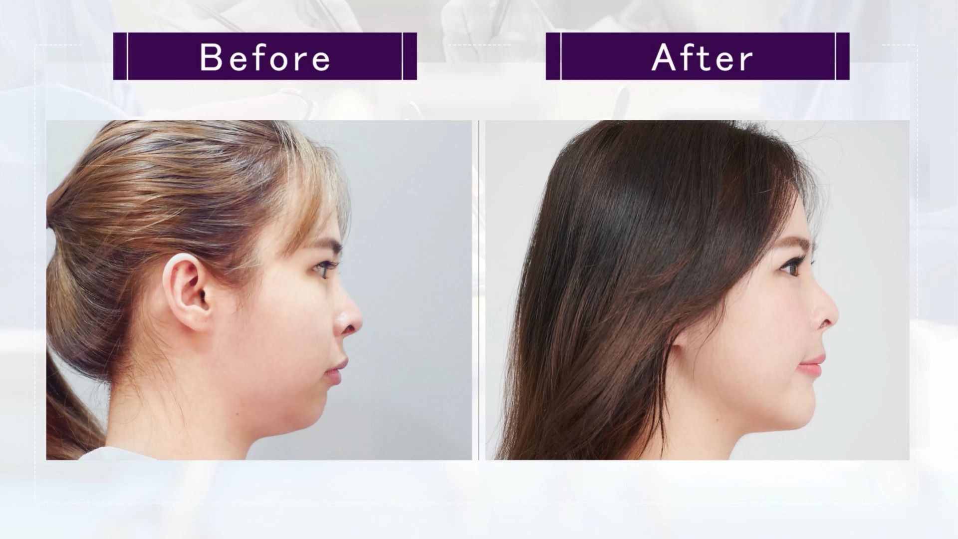 台中墊下巴整形手術權威醫師推薦價格費用009