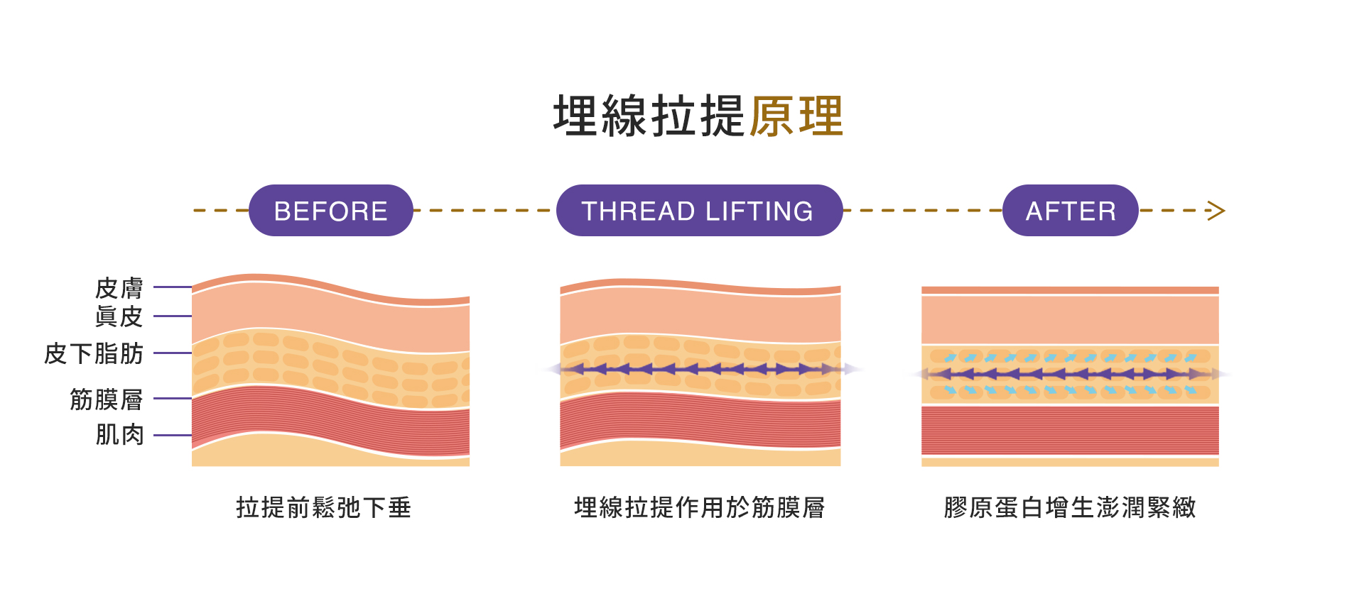 台中臉部埋線拉提拉皮001