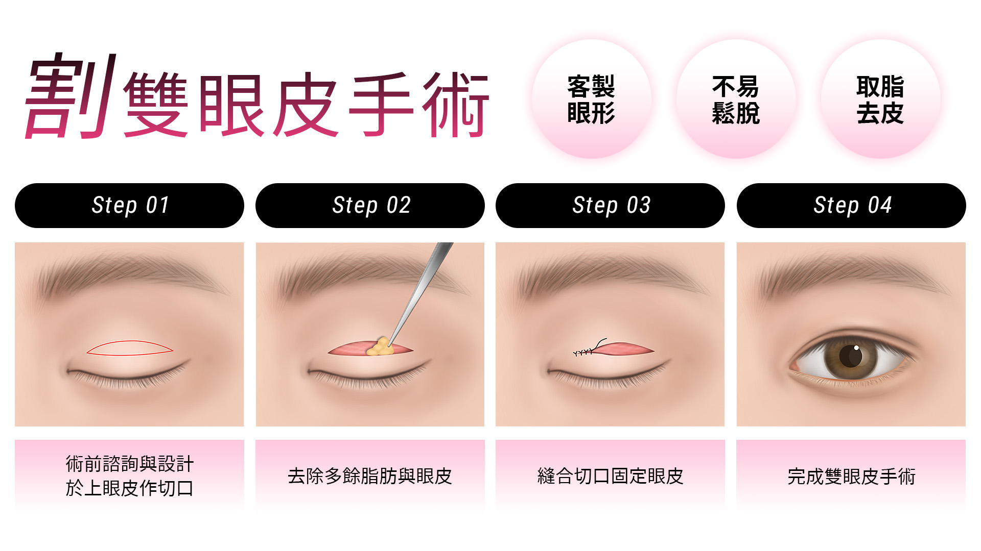 台中割雙眼皮手術