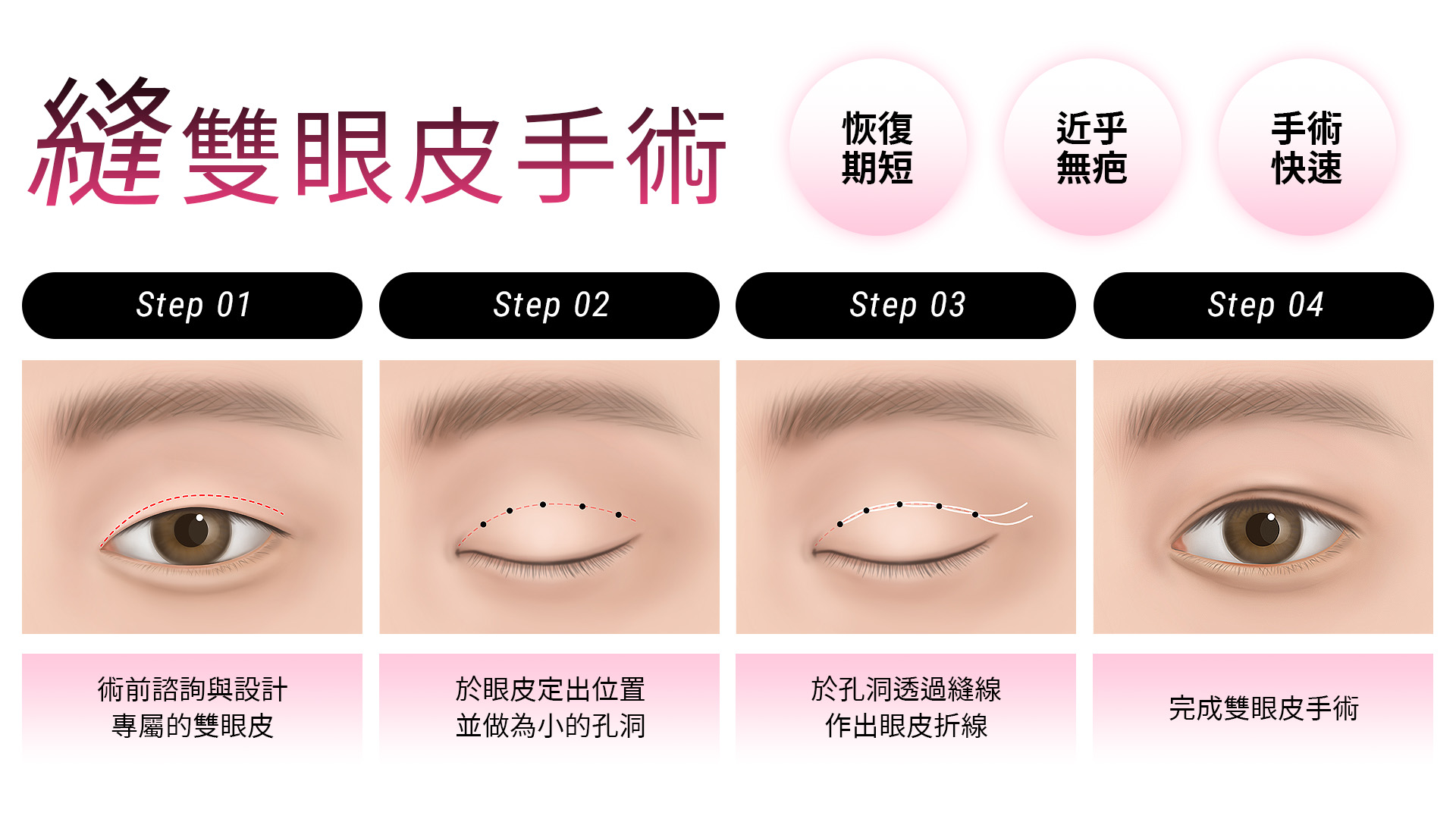 台中縫雙眼皮手術