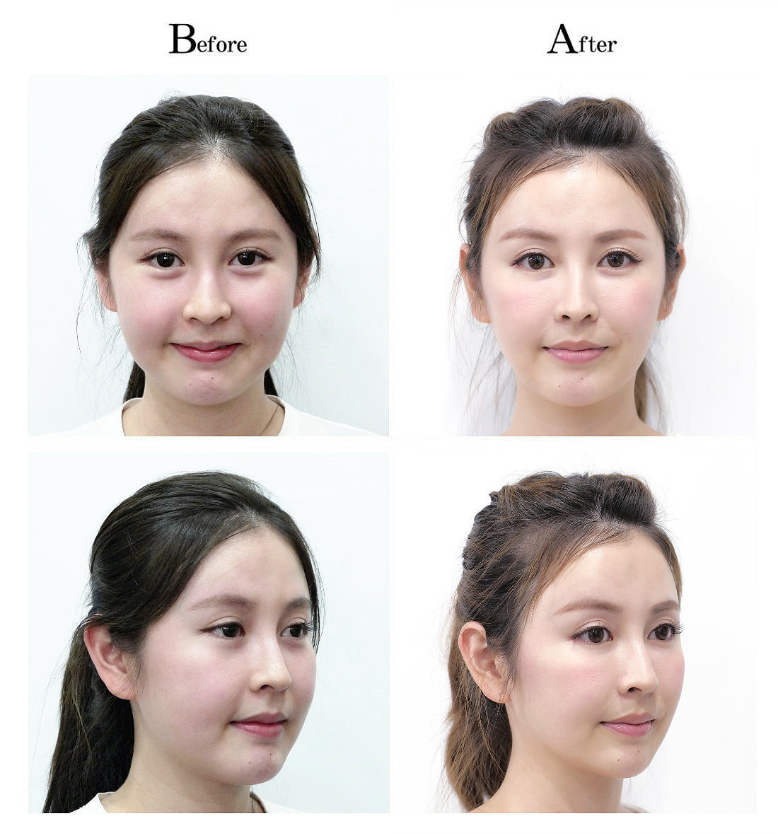 脸部音波拉提拉皮疗程前后比对照片