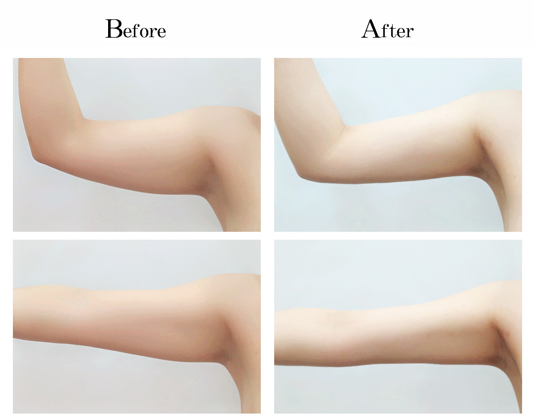 vaser lipo before and after arm
