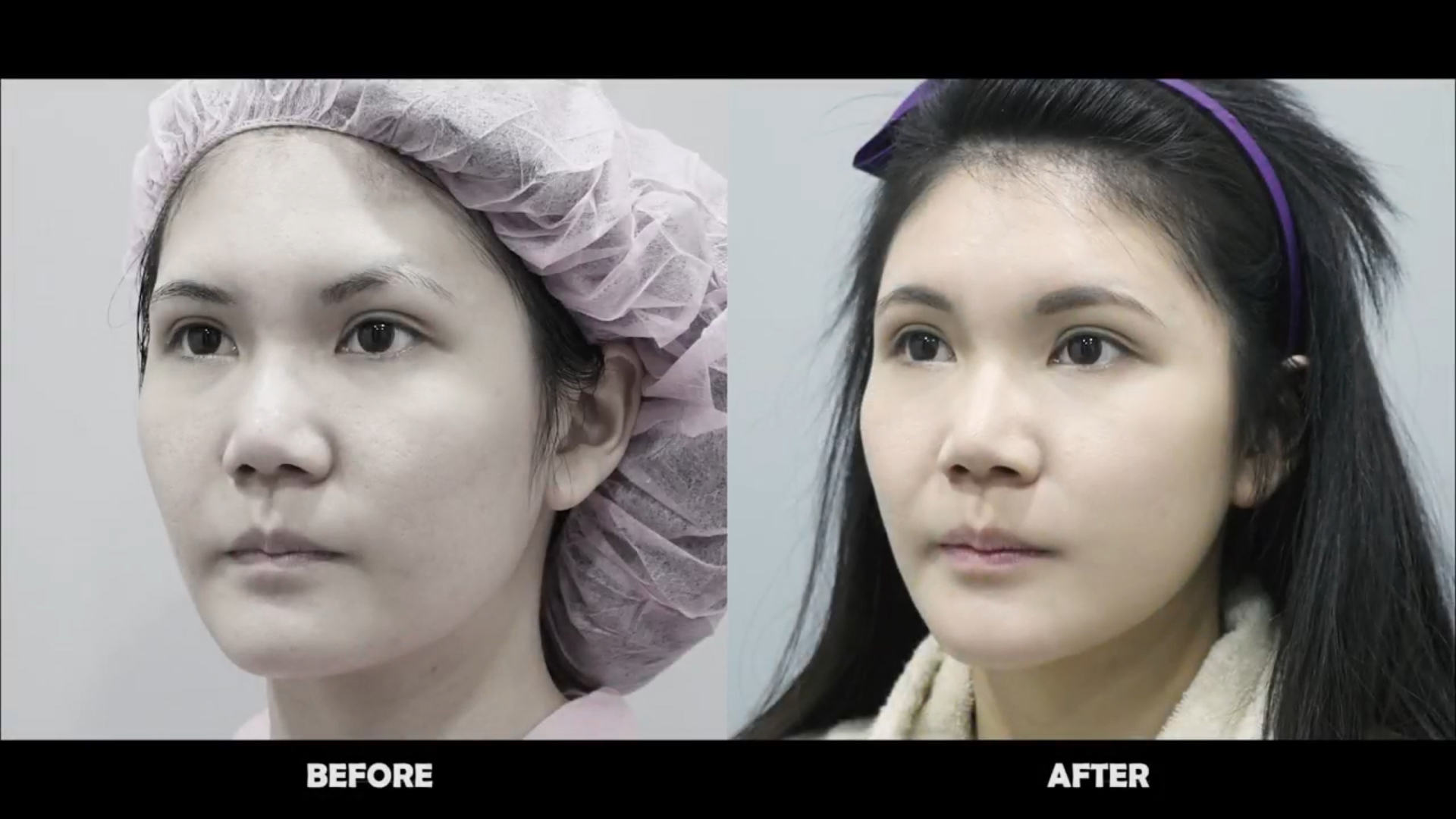 大腿抽脂自体脂肪移植补脸丰颊,部落客celine整形日记心得分享 台中