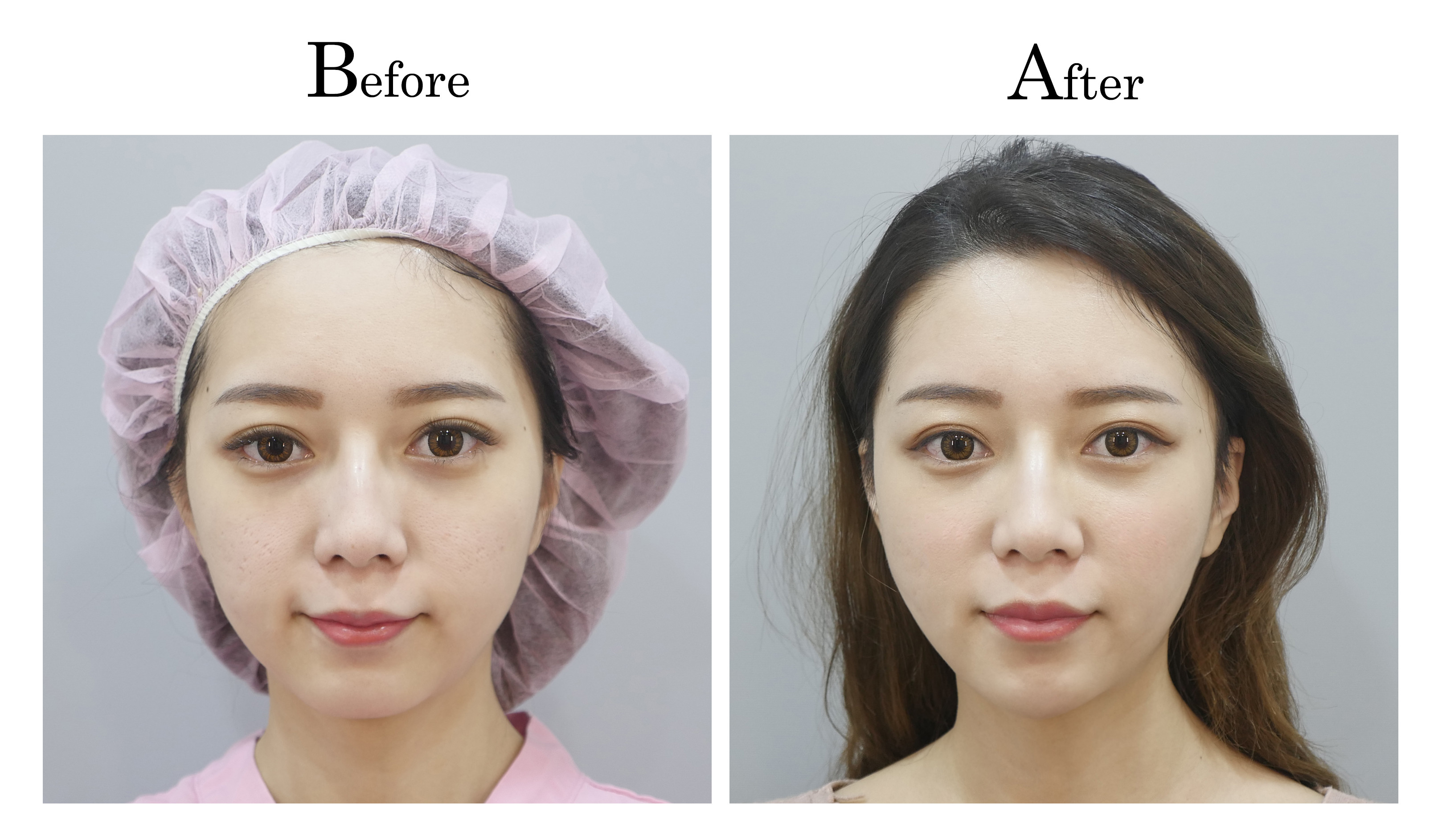 home > 服务项目 > 埋线拉提拉皮手术 台中服务项目 | service