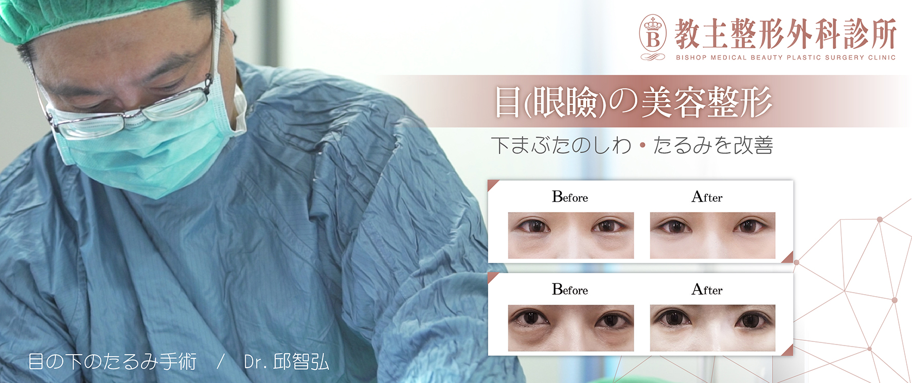 眼袋手術割除內開外開權威醫師邱智弘