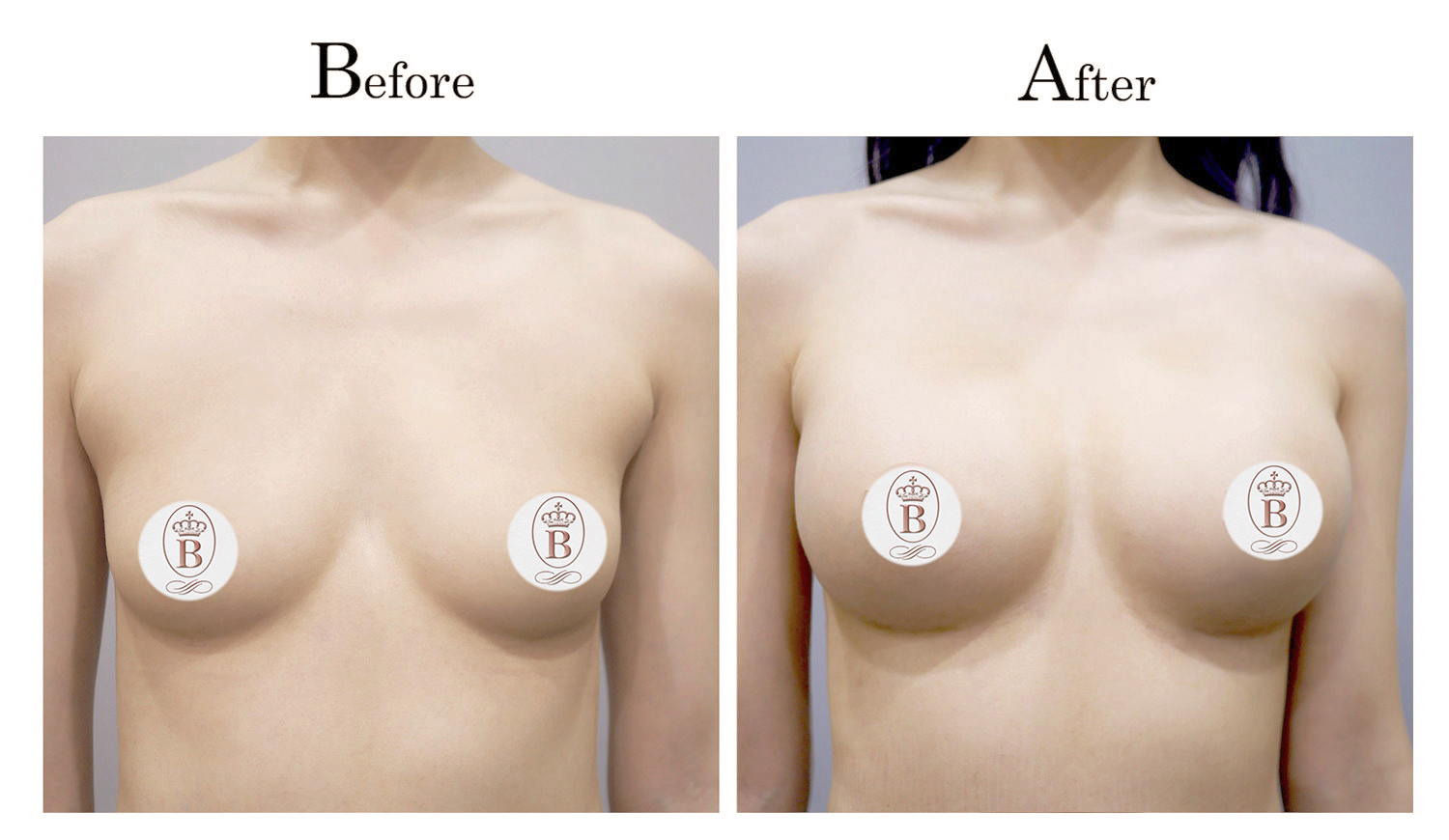 魔滴隆乳疤痕,Motiva台中魔滴隆乳