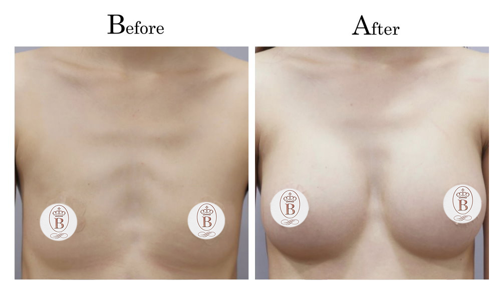 台中隆乳,台中隆乳權威,台中隆乳推薦,台中隆乳價格