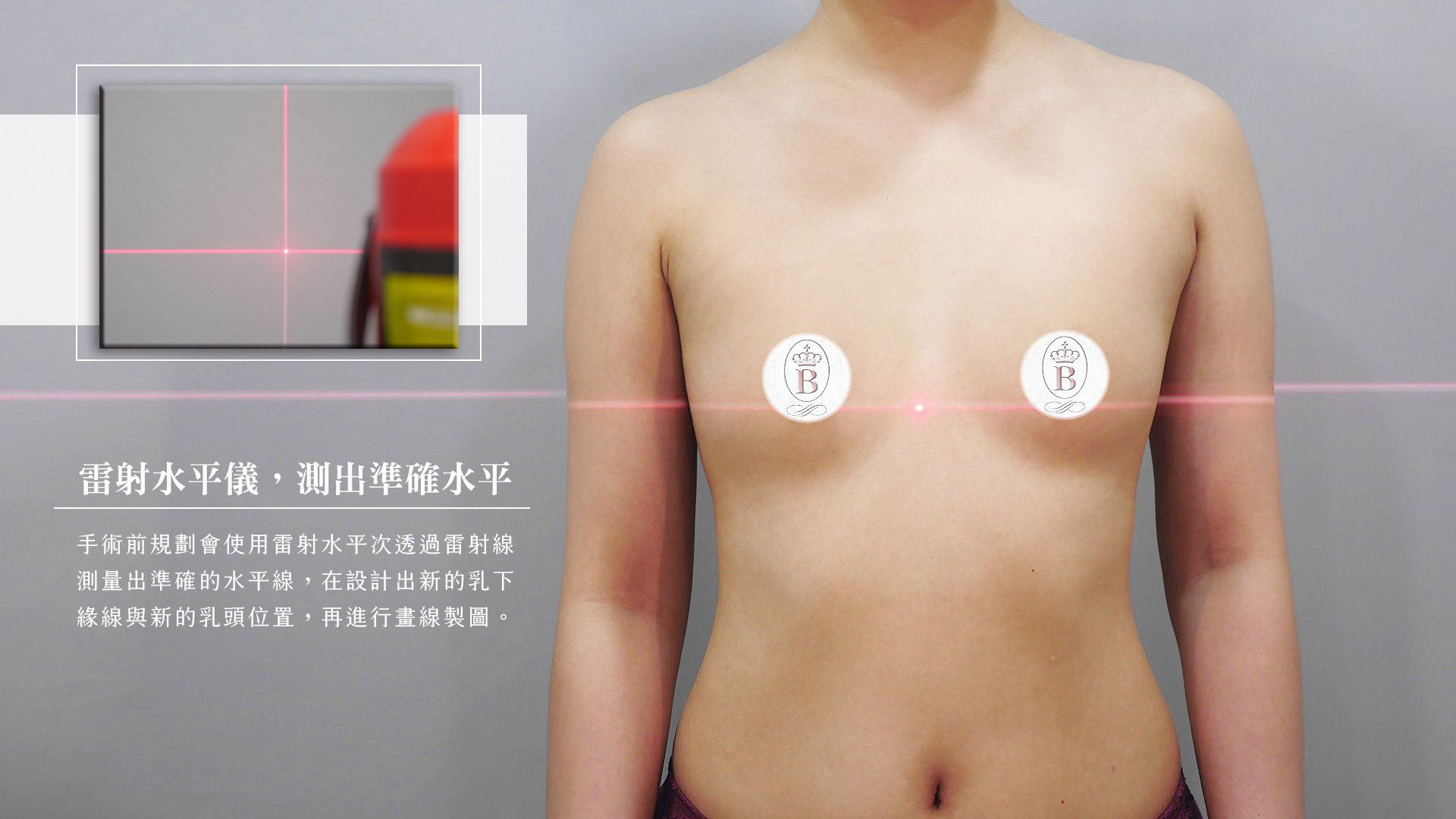 台中隆乳,大小奶隆乳,高低胸隆乳,台中隆乳權威邱智弘