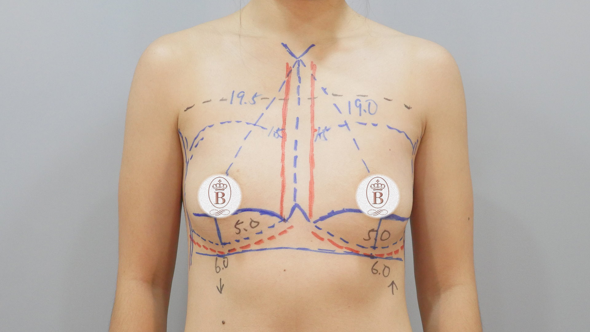 隆乳術前畫線,大小奶隆乳,高低胸隆乳,台中隆乳權威邱智弘