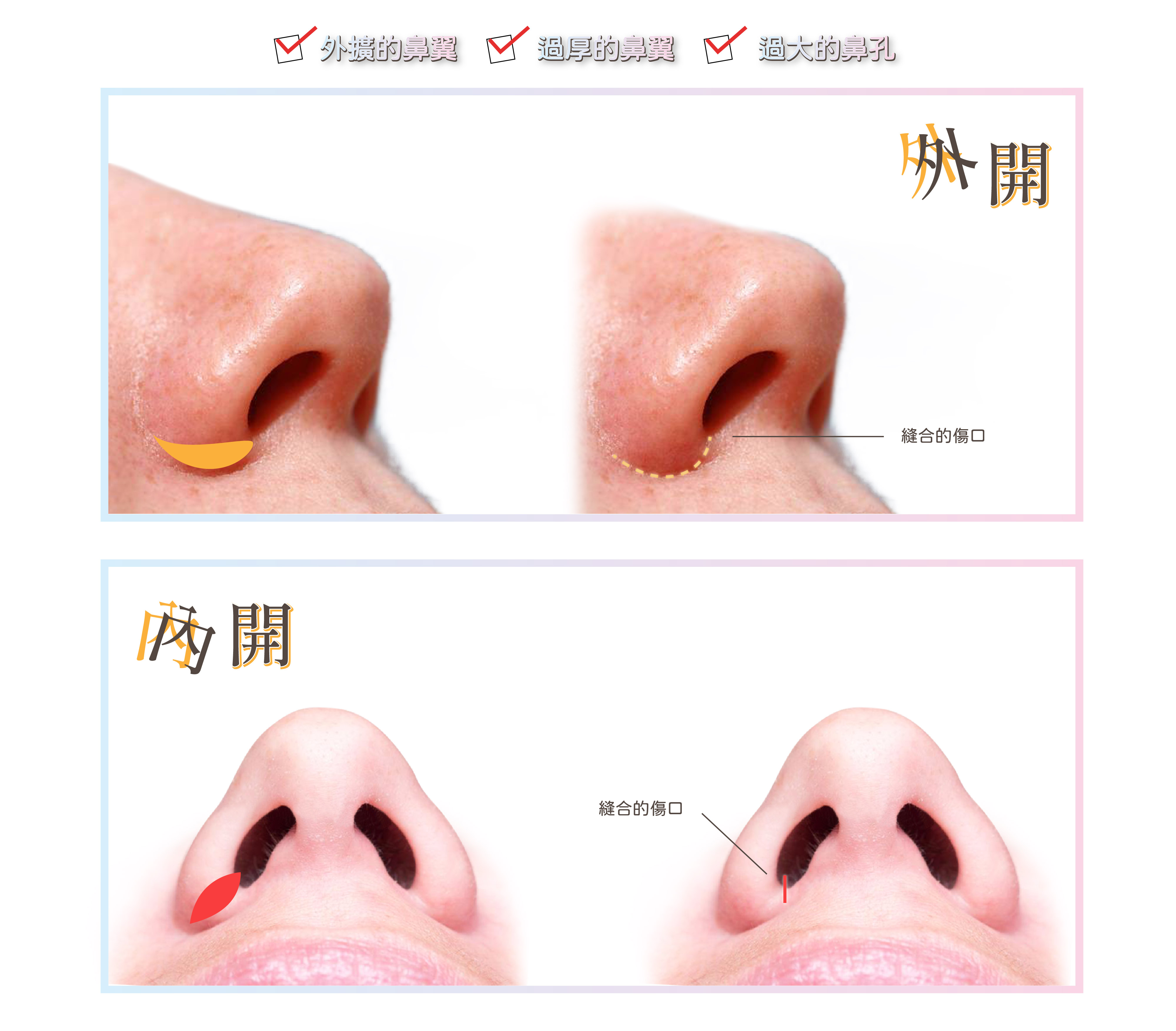 縮鼻翼縮鼻孔微創隱痕手術,將外闊過大的鼻翼以及鼻孔比例調整,精雕鼻型讓鼻部線條更玩美 台中教主醫美整? - 縮鼻翼縮鼻孔微創隱痕手術 台中 ...