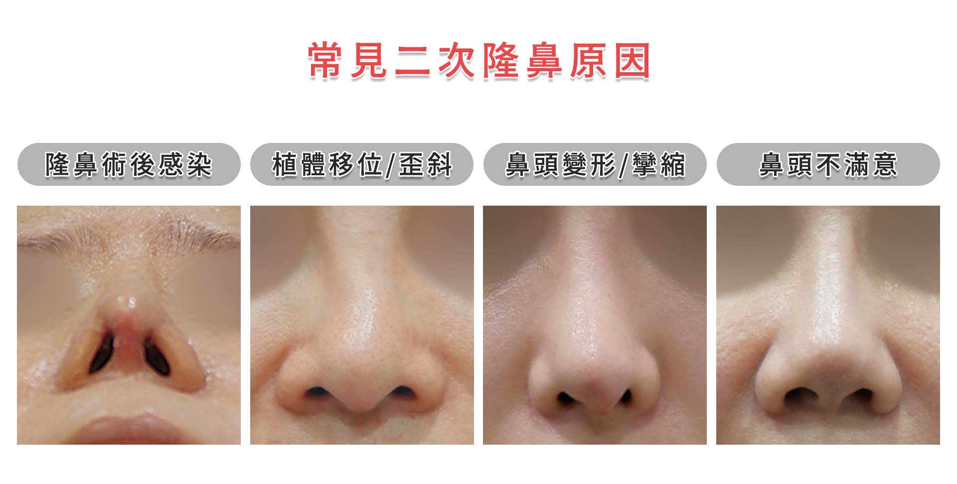 隆鼻手術失敗二次隆鼻整型重修重做手術說明 - 鼻頭塑型墊鼻頭手術 台中.嘉義.彰化.台南.高雄 - 服務項目 - 台中教主整形醫美權威醫師推薦 ...