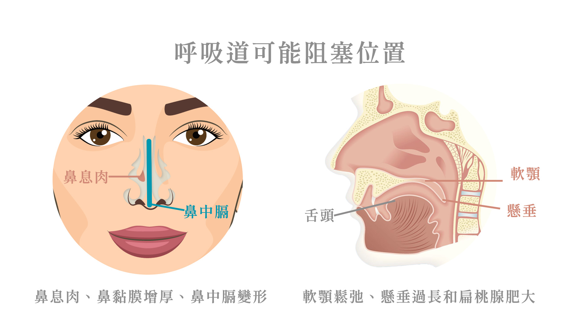 【止鼾手術介紹】透過手術方式打鼾打呼治療改善打呼打鼾,保險實支實付能理賠嗎? 台中教主醫美整形BishopC - 打鼾打呼治療止鼾手術 台中 ...